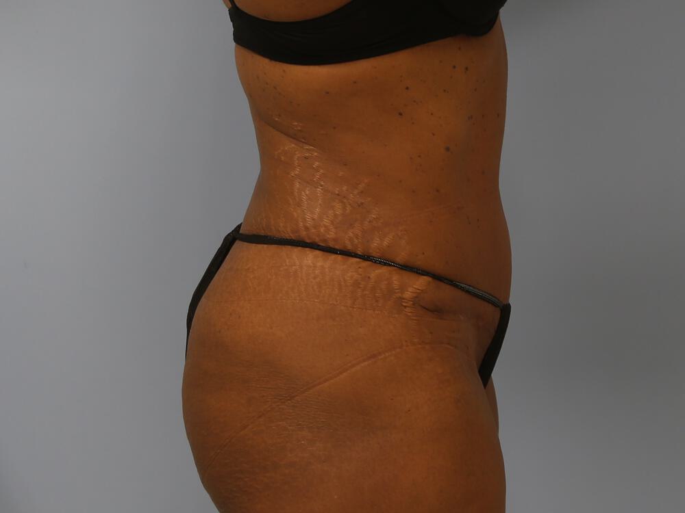 Tummy tuck Before & After Image
