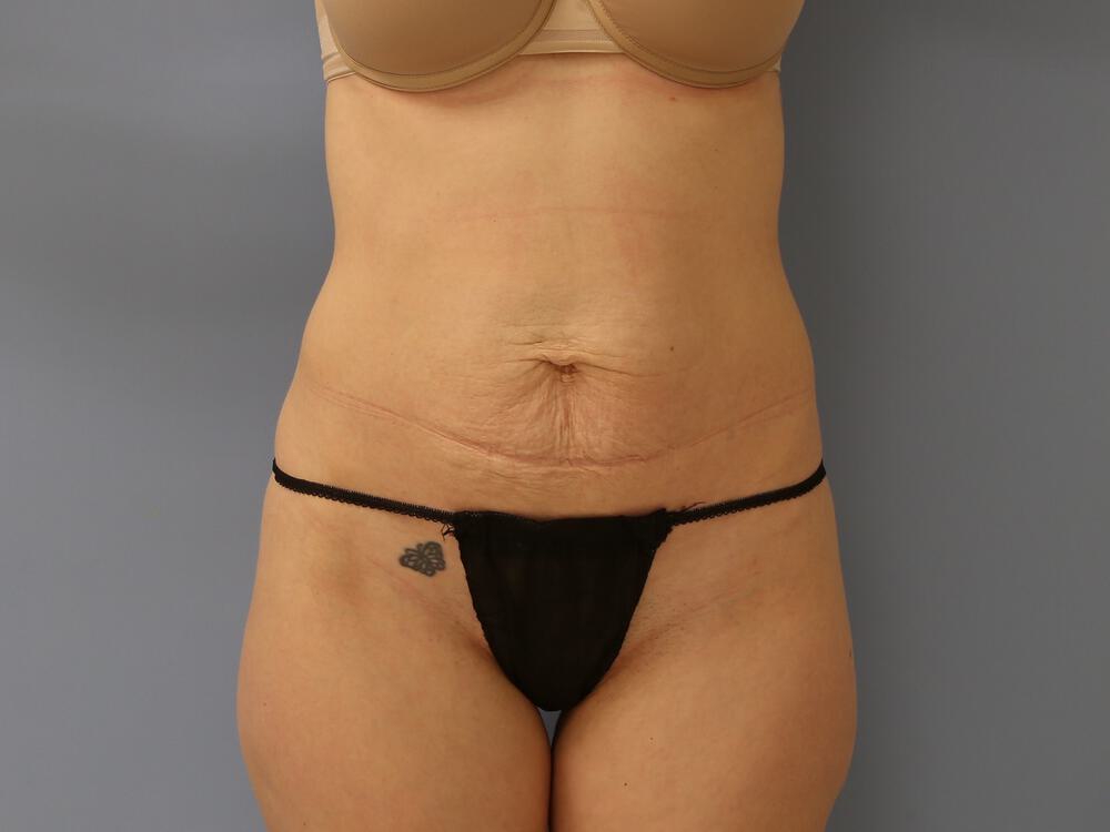 Tummy tuck Before & After Image