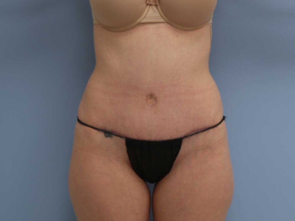 Tummy tuck Before & After Image