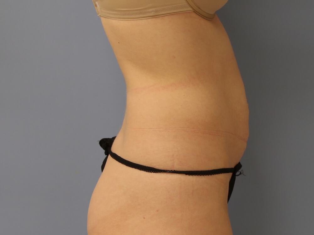 Tummy tuck Before & After Image