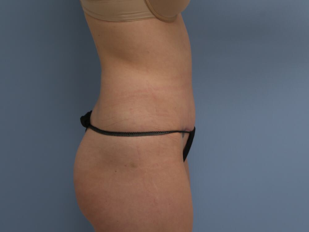 Tummy tuck Before & After Image