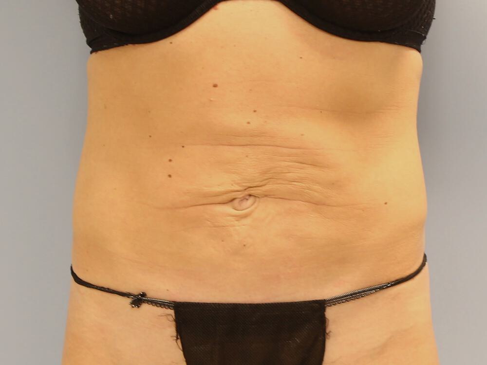 Tummy tuck Before & After Image