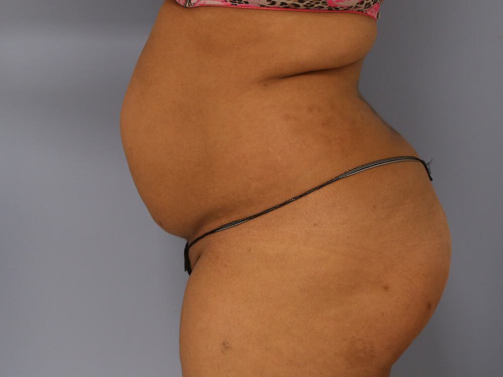 Tummy tuck Before & After Image