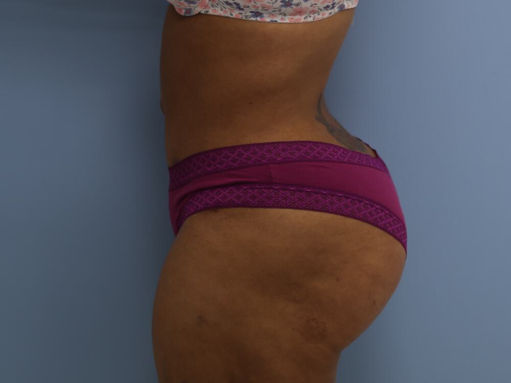 Tummy tuck Before & After Image