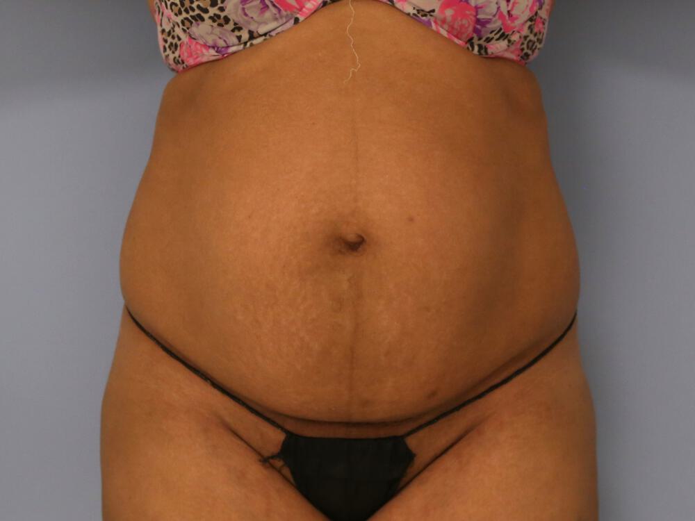 Tummy tuck Before & After Image