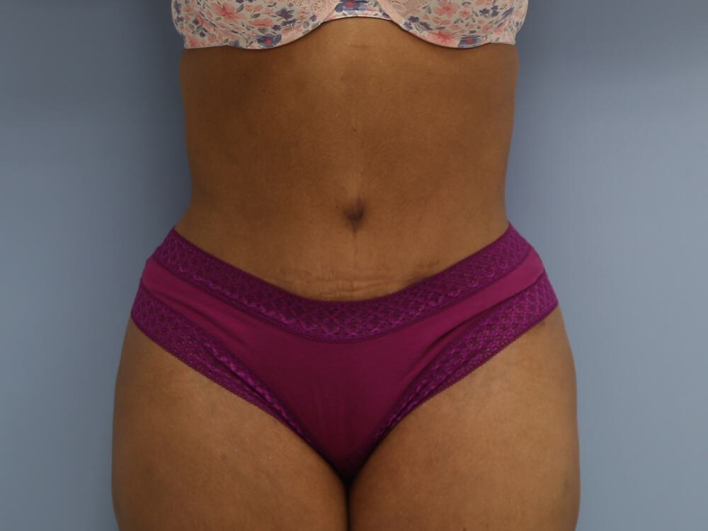 Tummy tuck Before & After Image