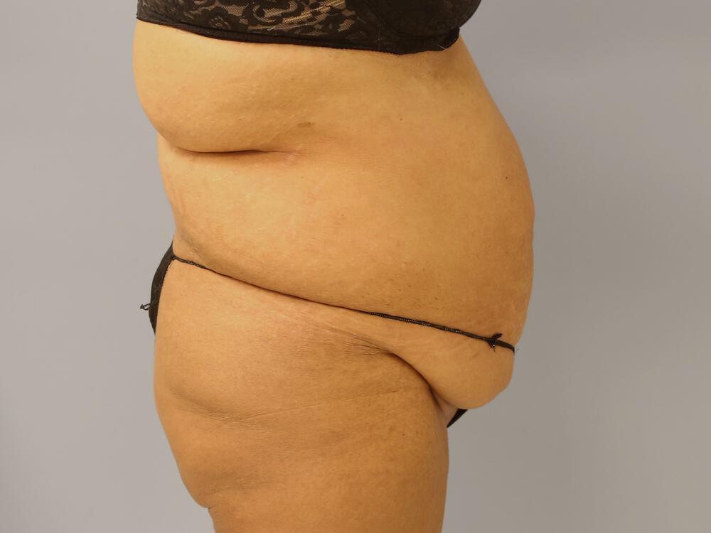 Tummy tuck Before & After Image