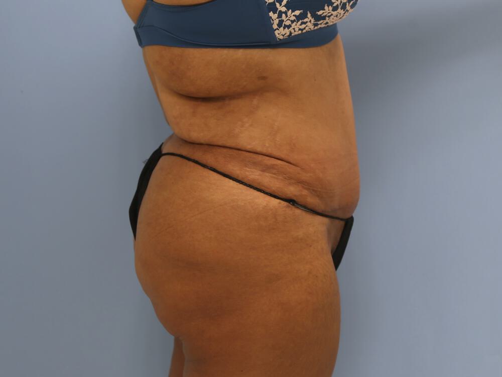 Tummy tuck Before & After Image