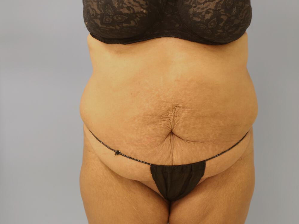 Tummy tuck Before & After Image