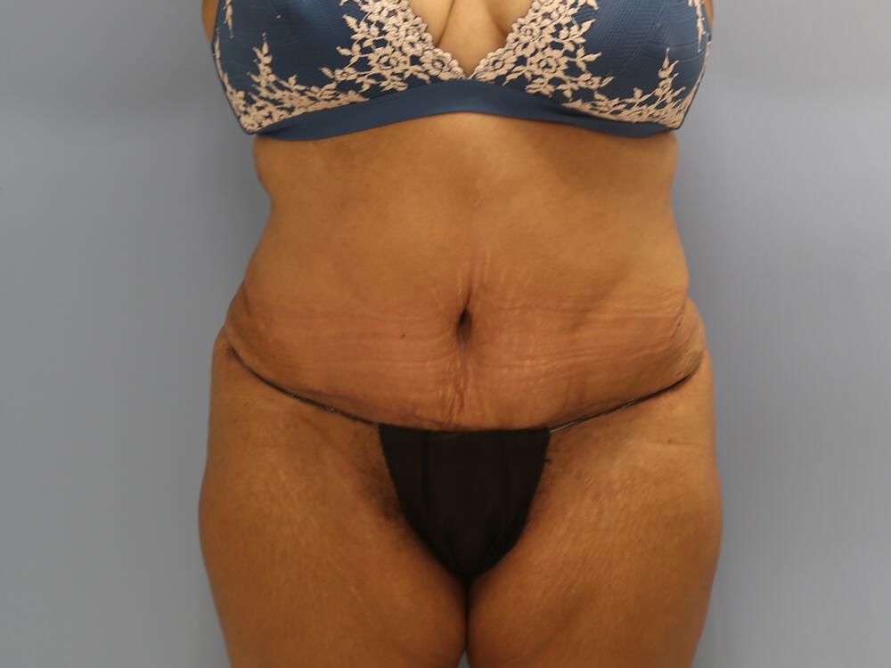 Tummy tuck Before & After Image