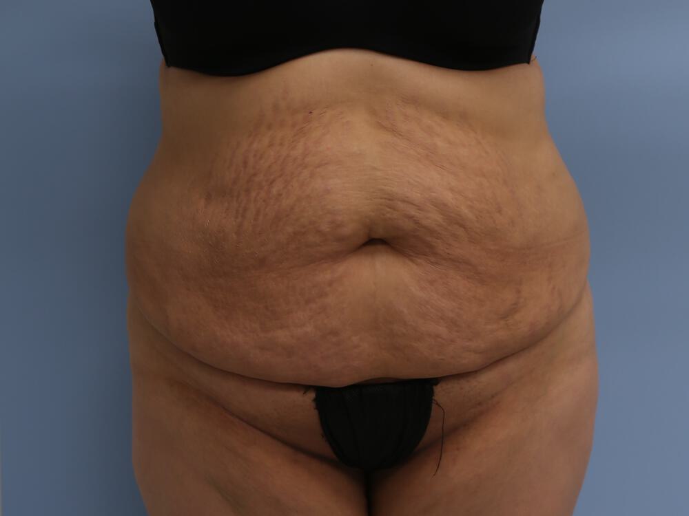 Tummy tuck Before & After Image
