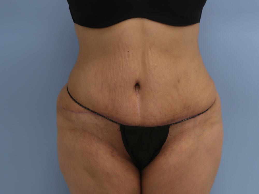 Tummy tuck Before & After Image