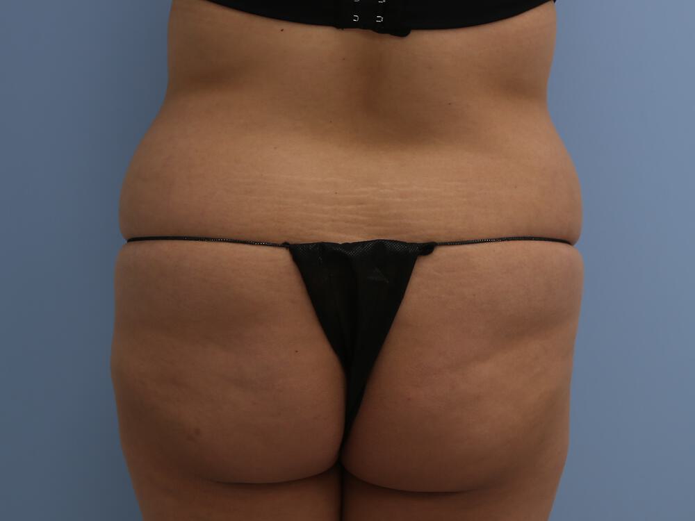 Tummy tuck Before & After Image
