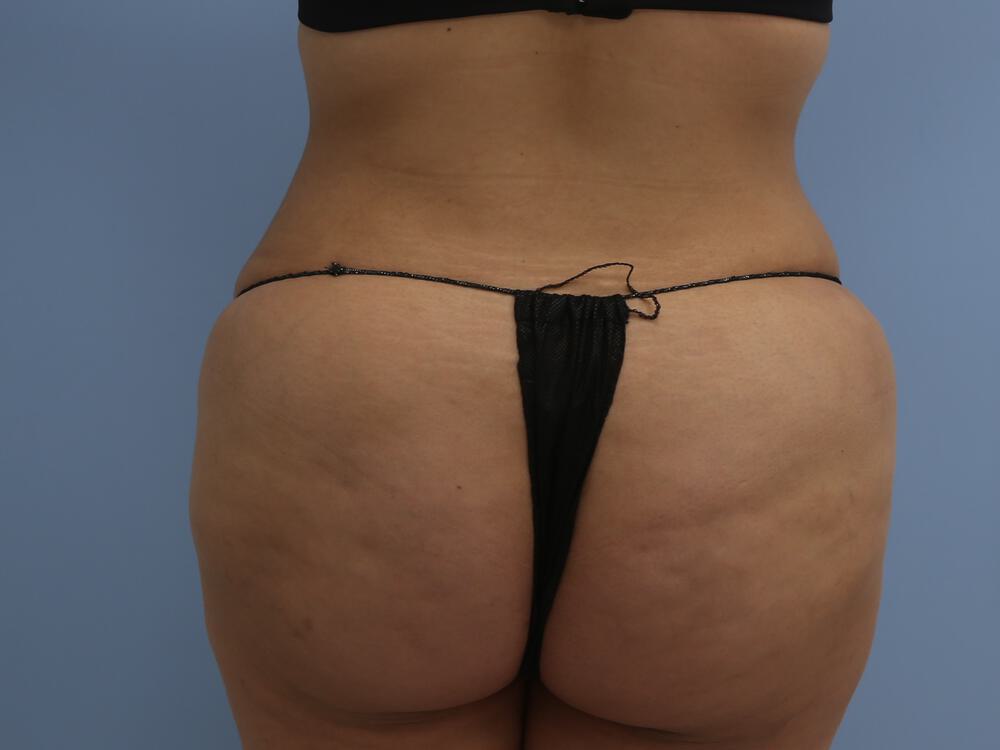 Tummy tuck Before & After Image