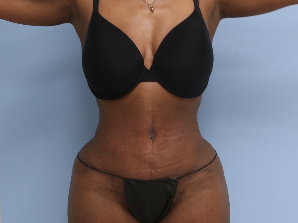 Tummy tuck Before & After Image