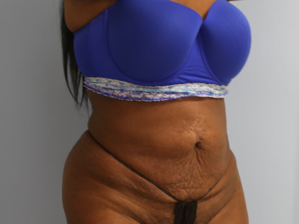 Tummy tuck Before & After Image