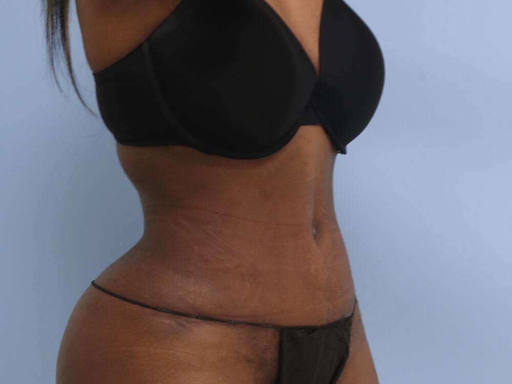 Tummy tuck Before & After Image