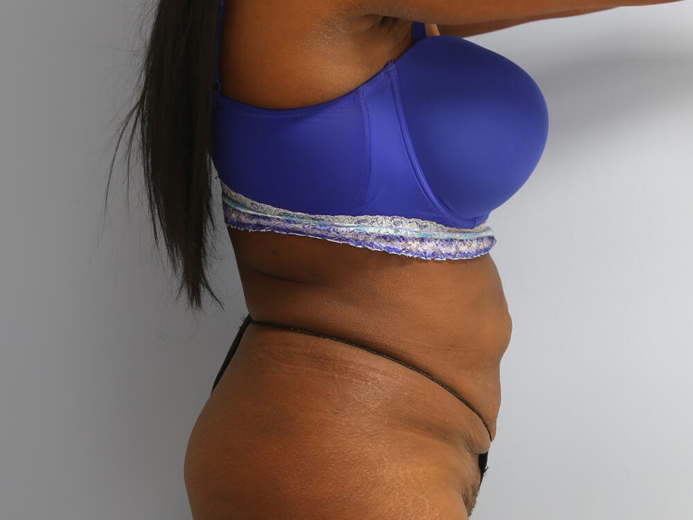 Tummy Tuck Before & After Image