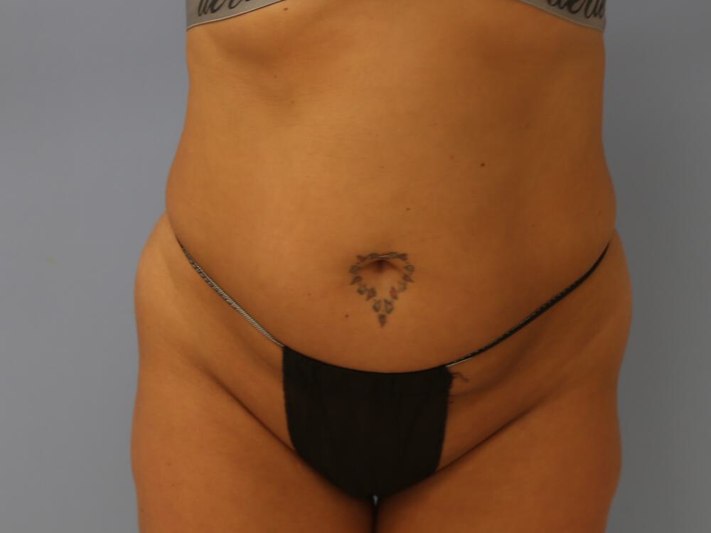 Tummy tuck Before & After Image