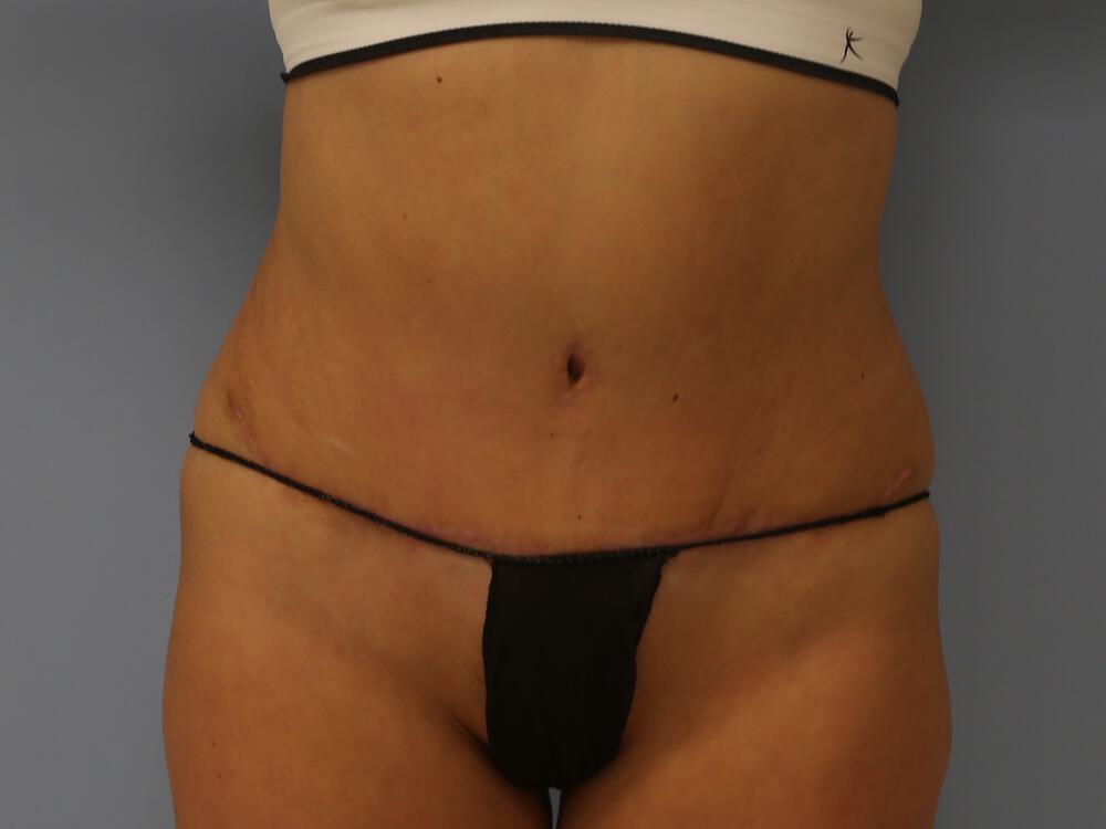 Tummy tuck Before & After Image