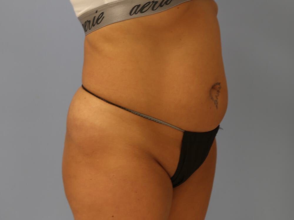 Tummy tuck Before & After Image
