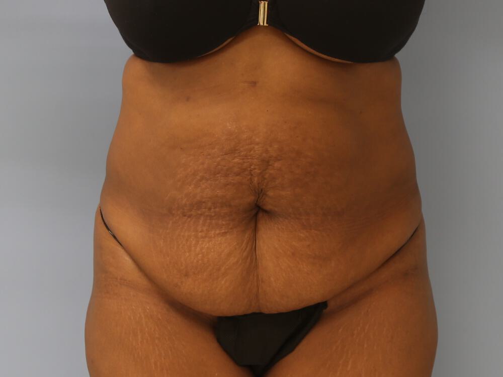 Tummy tuck Before & After Image