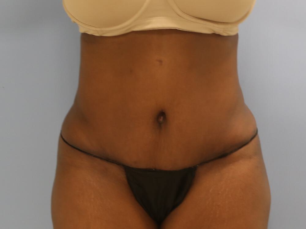 Tummy tuck Before & After Image