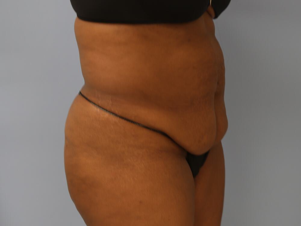 Tummy tuck Before & After Image