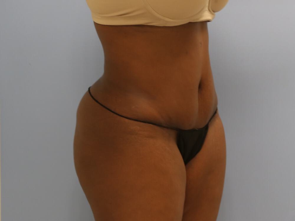 Tummy tuck Before & After Image