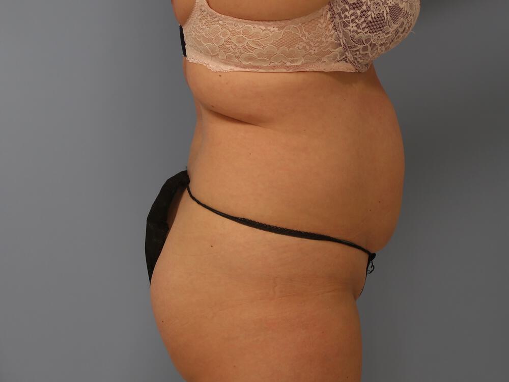 Tummy tuck Before & After Image