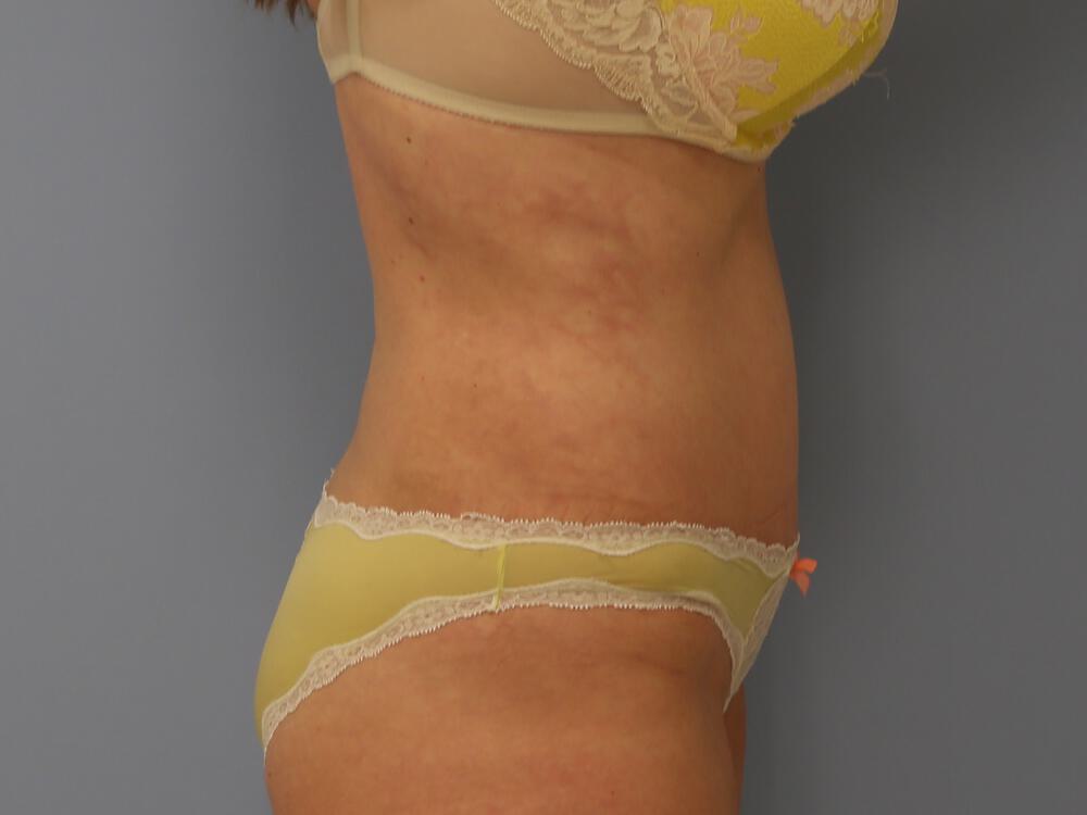 Tummy tuck Before & After Image