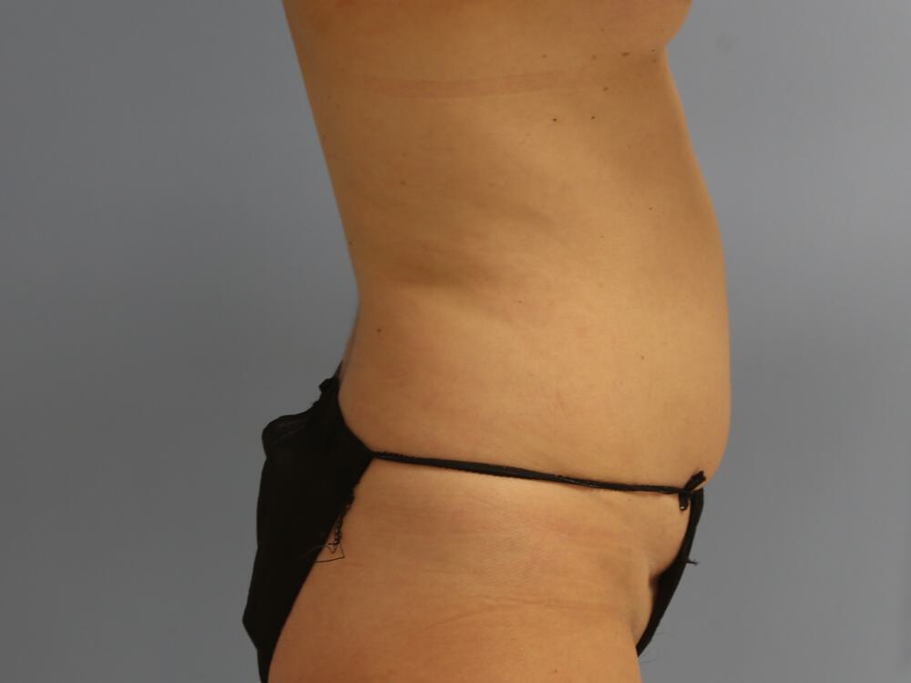Tummy tuck Before & After Image