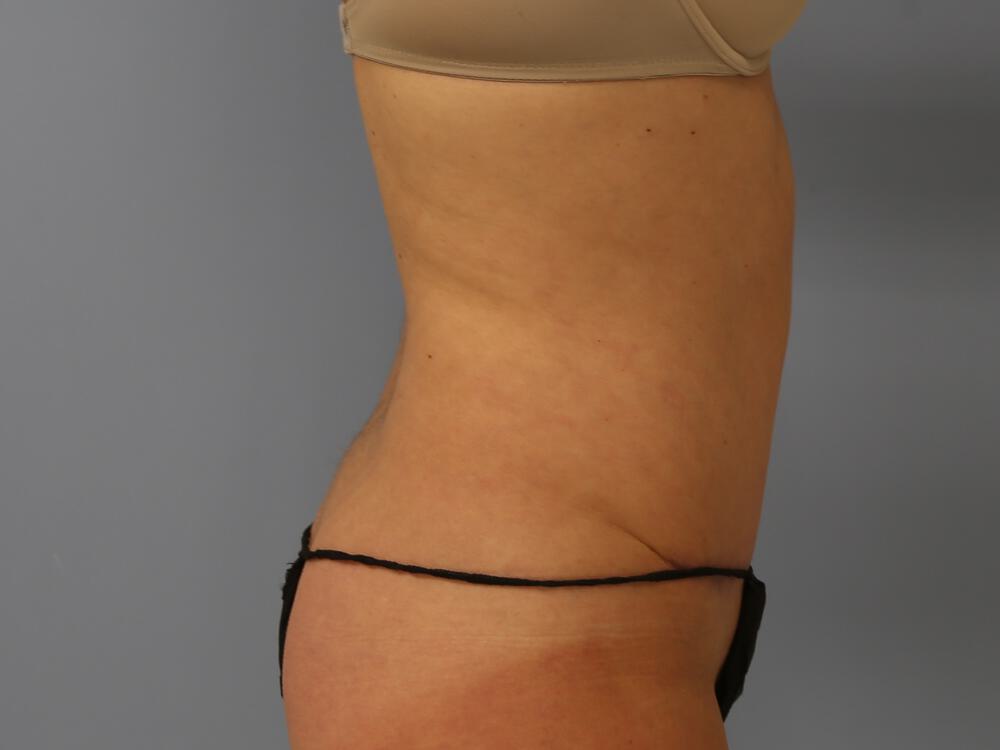 Tummy tuck Before & After Image