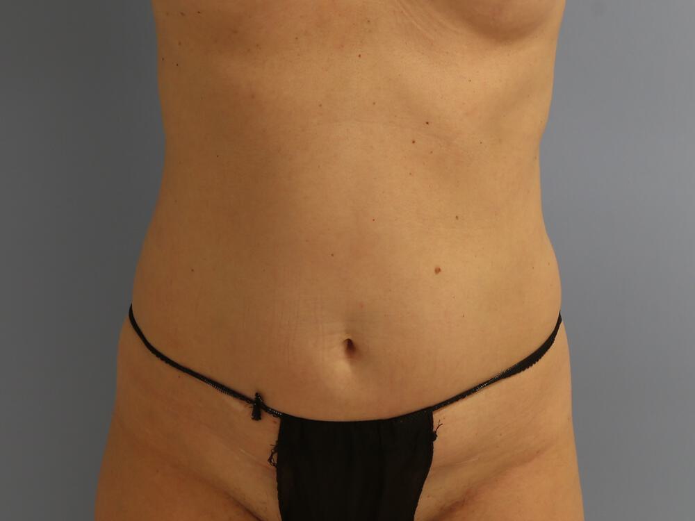Tummy tuck Before & After Image