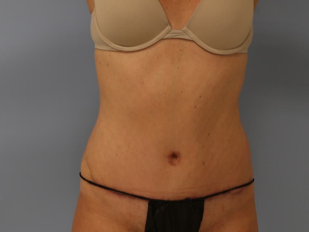 Tummy tuck Before & After Image