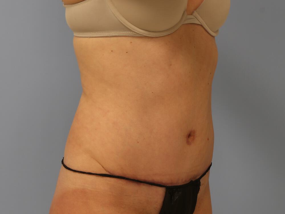 Tummy Tuck Before & After Image