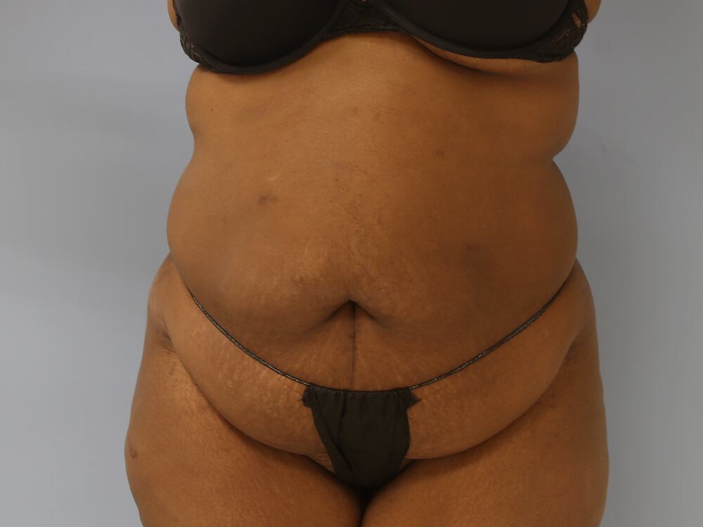 Tummy tuck Before & After Image