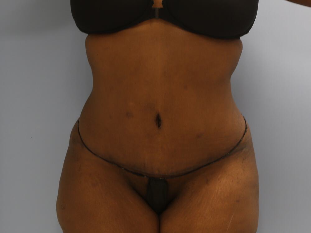 Tummy tuck Before & After Image
