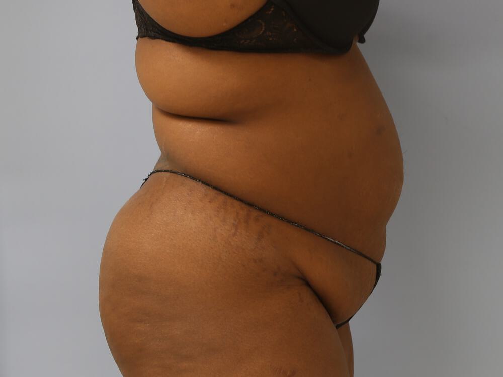 Tummy tuck Before & After Image