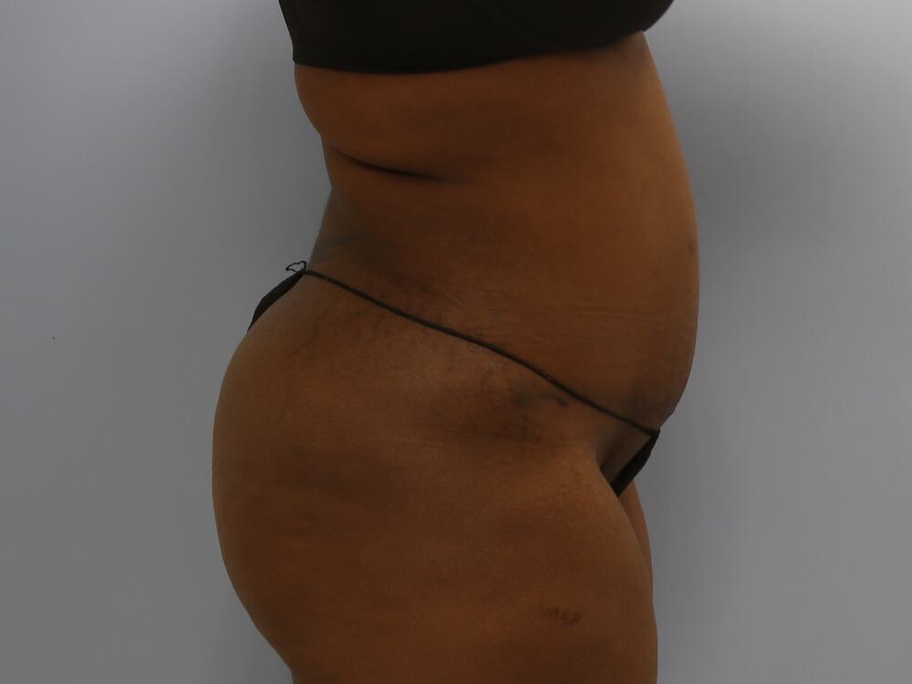 Tummy tuck Before & After Image