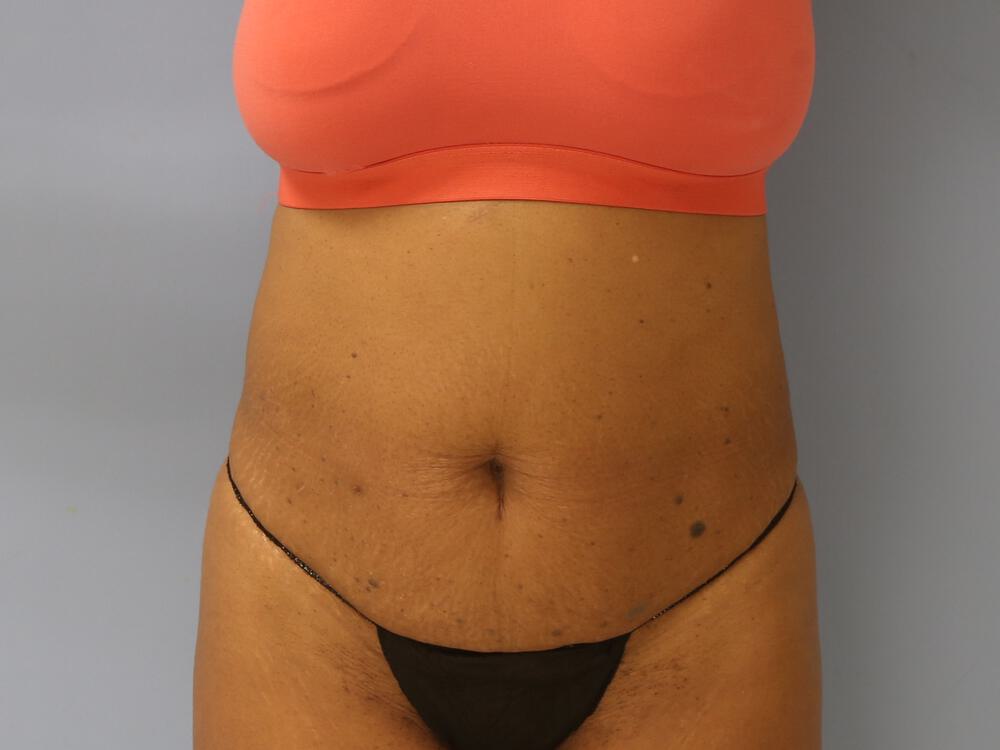 Tummy tuck Before & After Image