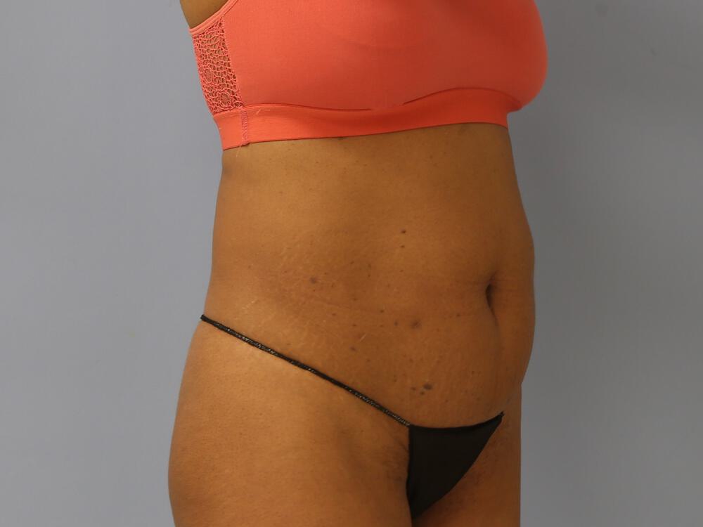 Tummy tuck Before & After Image