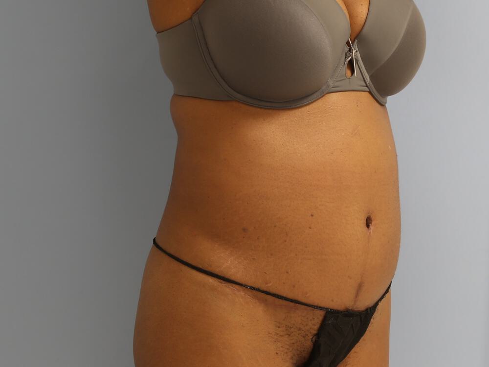 Tummy tuck Before & After Image