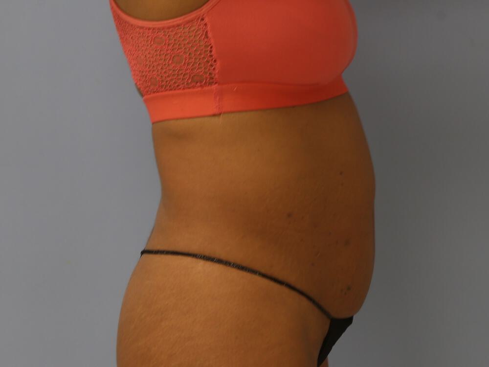 Tummy Tuck Before & After Image