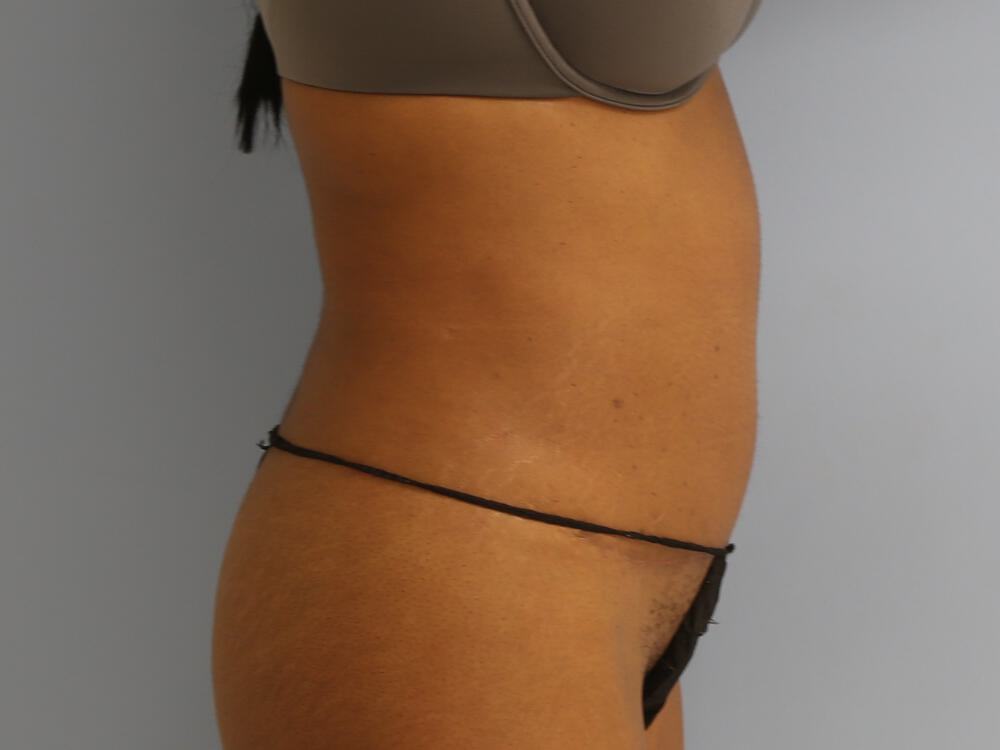 Tummy Tuck Before & After Image