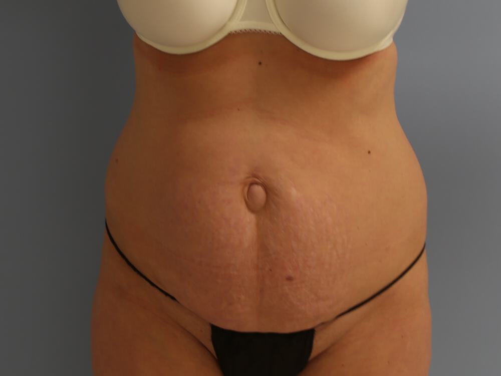 Tummy tuck Before & After Image
