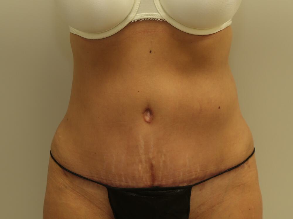 Tummy tuck Before & After Image