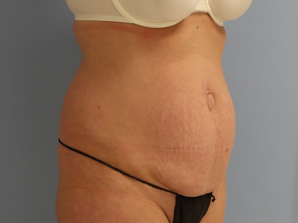 Tummy tuck Before & After Image