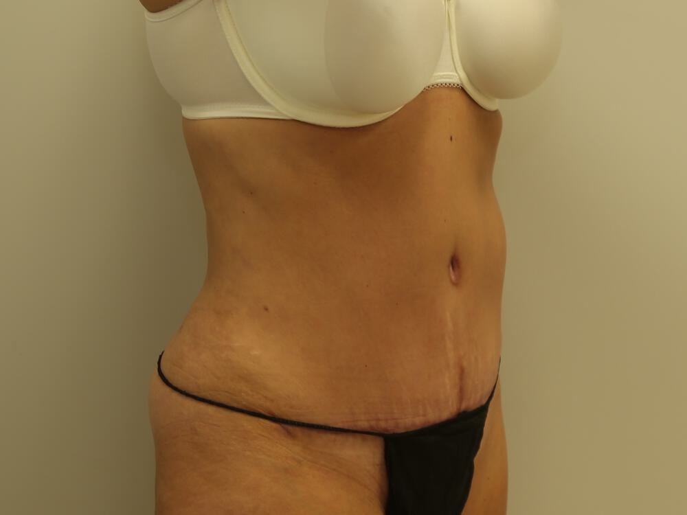 Tummy tuck Before & After Image