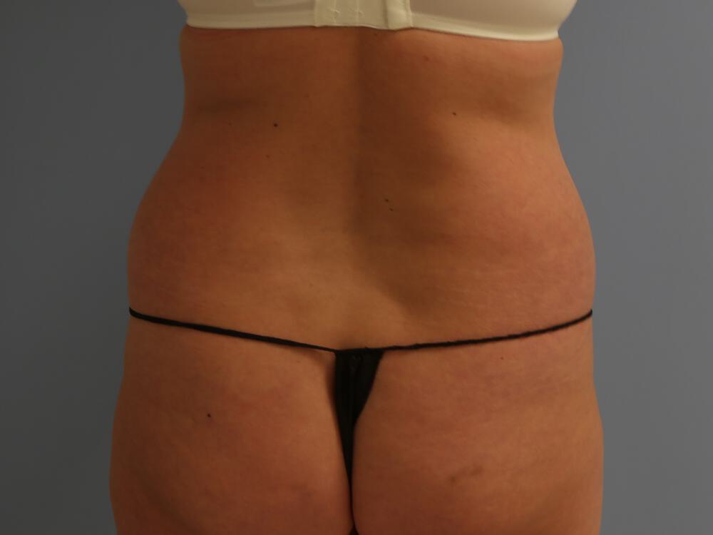Tummy Tuck Before & After Image